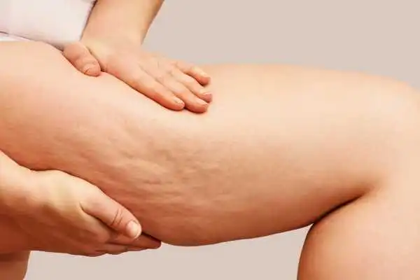 Image of woman showing leg with cellulite Coleshill