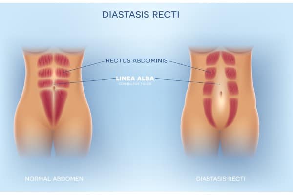 What Non-Surgical Options Are Available for Diastasis Recti Coleshill?