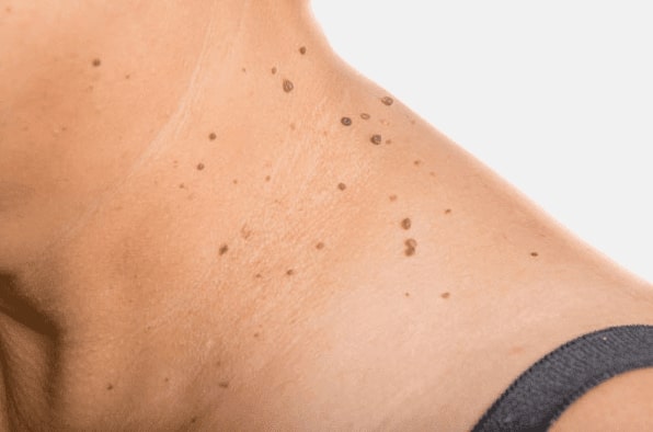 Are you looking for easy skin tag removal Coleshill - then contact Spire today!