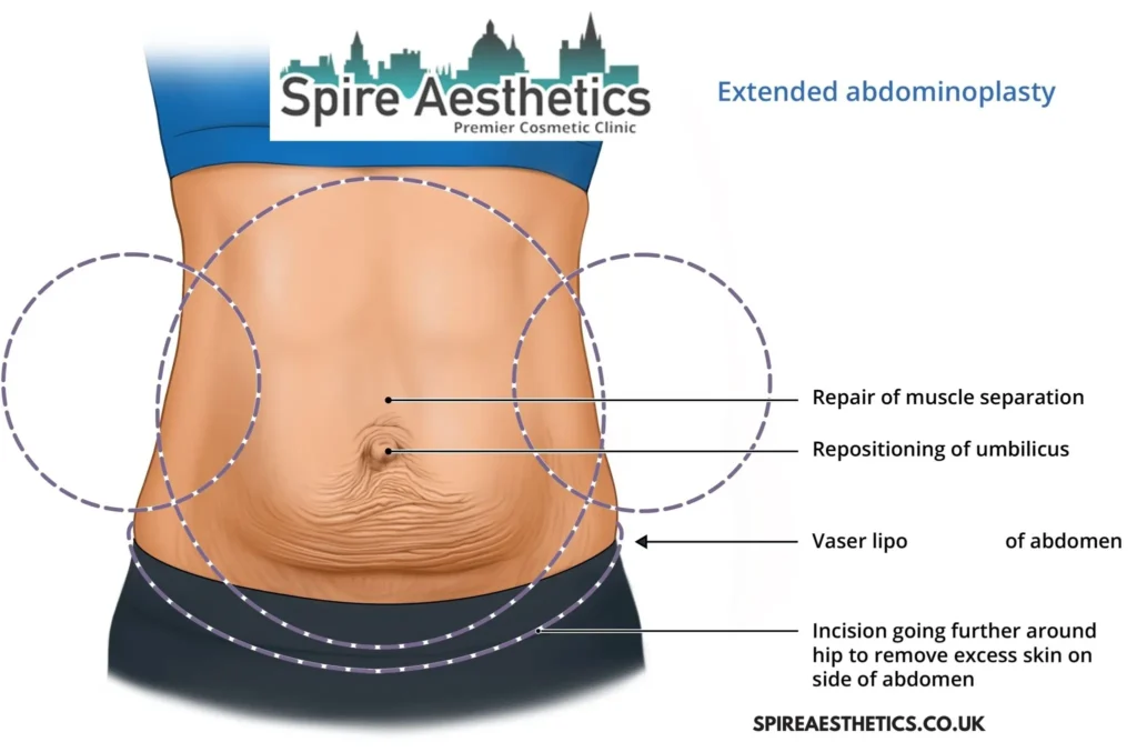 Understanding Loose Skin After Gastric Band Coleshill Surgery and HIFU Treatment