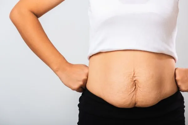 Image of a woman's stomach after weight loss with sagging skin following a gastric band Coleshill