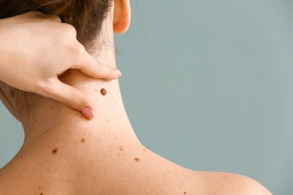skin blemish removal Coleshill treatment