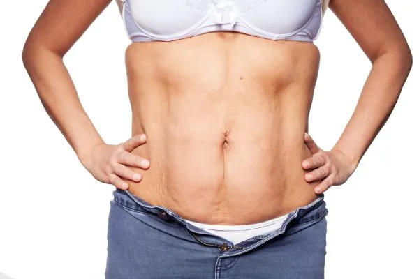 sagging skin on woman's stomach after weight loss injections Coleshill