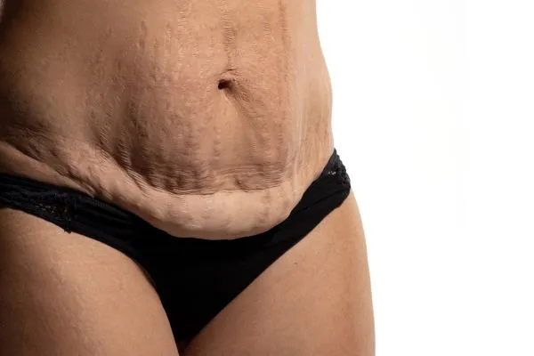 Image of womans stomach after weight loss injections Coleshill showing saggy skin