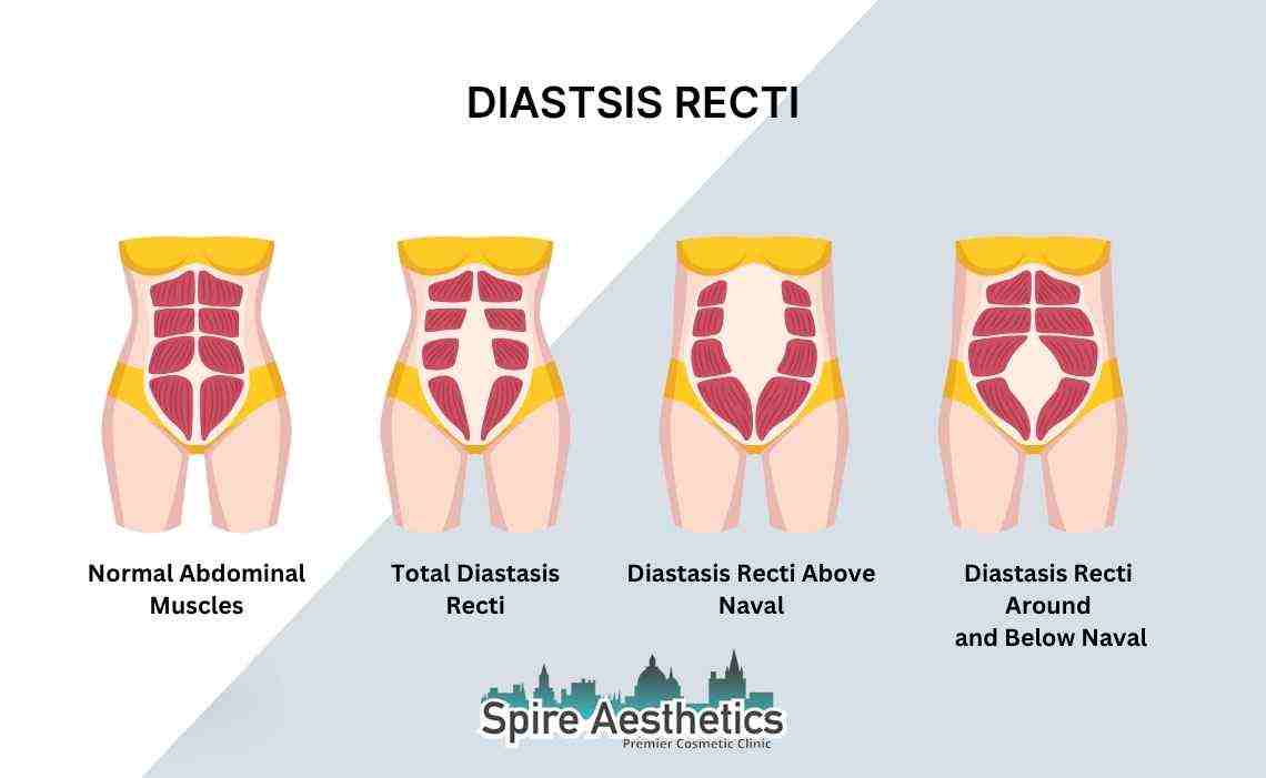 Is Non-Surgical Diastasis Recti Treatment Right for You? Common Concerns Answered Coleshill